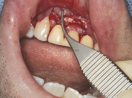 Пинцет стоматологический Micro-Adson изогнутый с крючком фото 4